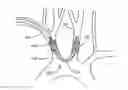 Fig. 01 - Embolic protection during percutaneous heart valve replacement and similar procedures
