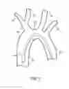 Fig. 02 - Embolic protection during percutaneous heart valve replacement and similar procedures
