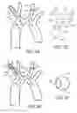 Fig. 04 - Embolic protection during percutaneous heart valve replacement and similar procedures