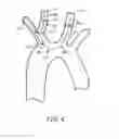 Fig. 05 - Embolic protection during percutaneous heart valve replacement and similar procedures