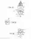 Fig. 10 - Embolic protection during percutaneous heart valve replacement and similar procedures