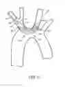 Fig. 13 - Embolic protection during percutaneous heart valve replacement and similar procedures