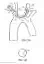 Fig. 14 - Embolic protection during percutaneous heart valve replacement and similar procedures