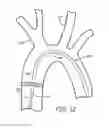 Fig. 15 - Embolic protection during percutaneous heart valve replacement and similar procedures