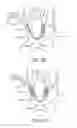 Fig. 17 - Embolic protection during percutaneous heart valve replacement and similar procedures