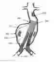 Fig. 01 - Aneurysm Graft With Stabilization