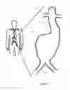 Fig. 02 - Aneurysm Graft With Stabilization