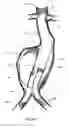 Fig. 06 - Aneurysm Graft With Stabilization