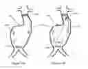 Fig. 08 - Aneurysm Graft With Stabilization