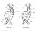 Fig. 09 - Aneurysm Graft With Stabilization