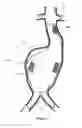 Fig. 11 - Aneurysm Graft With Stabilization