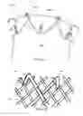 Fig. 15 - Aneurysm Graft With Stabilization