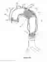 Fig. 17 - Aneurysm Graft With Stabilization