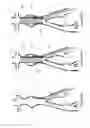 Fig. 19 - Aneurysm Graft With Stabilization
