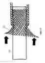 Fig. 20 - Aneurysm Graft With Stabilization