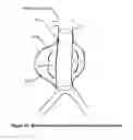 Fig. 23 - Aneurysm Graft With Stabilization