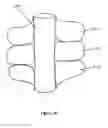 Fig. 24 - Aneurysm Graft With Stabilization