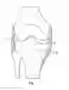 Fig. 02 - System and method for load balancing in knee replacement procedures