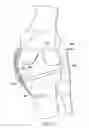 Fig. 10 - System and method for load balancing in knee replacement procedures
