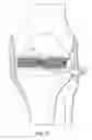 Fig. 16 - System and method for load balancing in knee replacement procedures