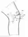 Fig. 01 - Tissue capturing bone anchor