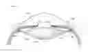 Fig. 01 - Piezoelectric sensor for vision correction