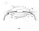 Fig. 02 - Piezoelectric sensor for vision correction