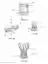 Fig. 07 - Means for Controlled Sealing of Endovascular Devices