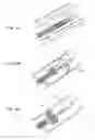 Fig. 09 - Means for Controlled Sealing of Endovascular Devices