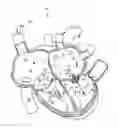 Fig. 01 - Apparatus, system, and method for treating a regurgitant heart valve
