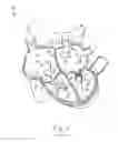 Fig. 03 - Apparatus, system, and method for treating a regurgitant heart valve