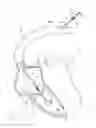 Fig. 10 - Apparatus, system, and method for treating a regurgitant heart valve