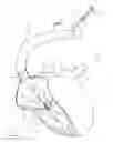 Fig. 11 - Apparatus, system, and method for treating a regurgitant heart valve