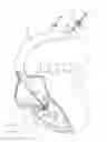 Fig. 12 - Apparatus, system, and method for treating a regurgitant heart valve