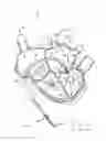 Fig. 15 - Apparatus, system, and method for treating a regurgitant heart valve