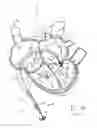 Fig. 16 - Apparatus, system, and method for treating a regurgitant heart valve