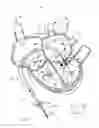 Fig. 17 - Apparatus, system, and method for treating a regurgitant heart valve