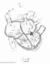 Fig. 18 - Apparatus, system, and method for treating a regurgitant heart valve