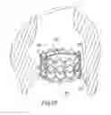 Fig. 30 - Prosthetic heart valve and method