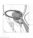 Fig. 01 - Implant and method for improving coaptation of an atrioventricular valve