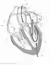 Fig. 02 - Implant and method for improving coaptation of an atrioventricular valve