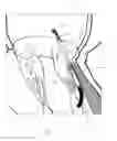 Fig. 03 - Implant and method for improving coaptation of an atrioventricular valve