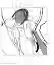 Fig. 04 - Implant and method for improving coaptation of an atrioventricular valve