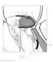 Fig. 05 - Implant and method for improving coaptation of an atrioventricular valve