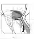 Fig. 06 - Implant and method for improving coaptation of an atrioventricular valve