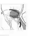 Fig. 07 - Implant and method for improving coaptation of an atrioventricular valve