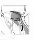 Fig. 08 - Implant and method for improving coaptation of an atrioventricular valve