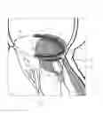 Fig. 09 - Implant and method for improving coaptation of an atrioventricular valve