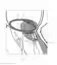 Fig. 10 - Implant and method for improving coaptation of an atrioventricular valve