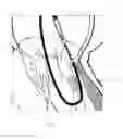 Fig. 11 - Implant and method for improving coaptation of an atrioventricular valve